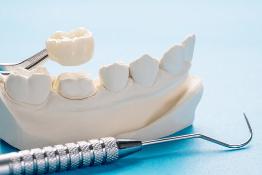 Dental crown being fitted onto a prepared tooth on a study model